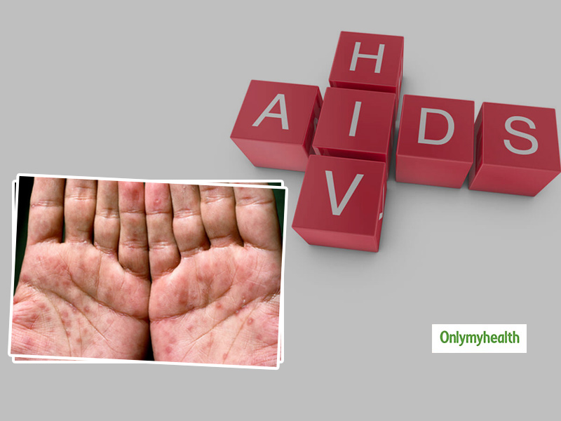 Hiv Dry Skin Patches