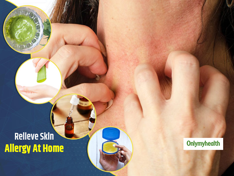 Do You Have Skin Allergies? These Home Remedies Can Come To Your Rescue