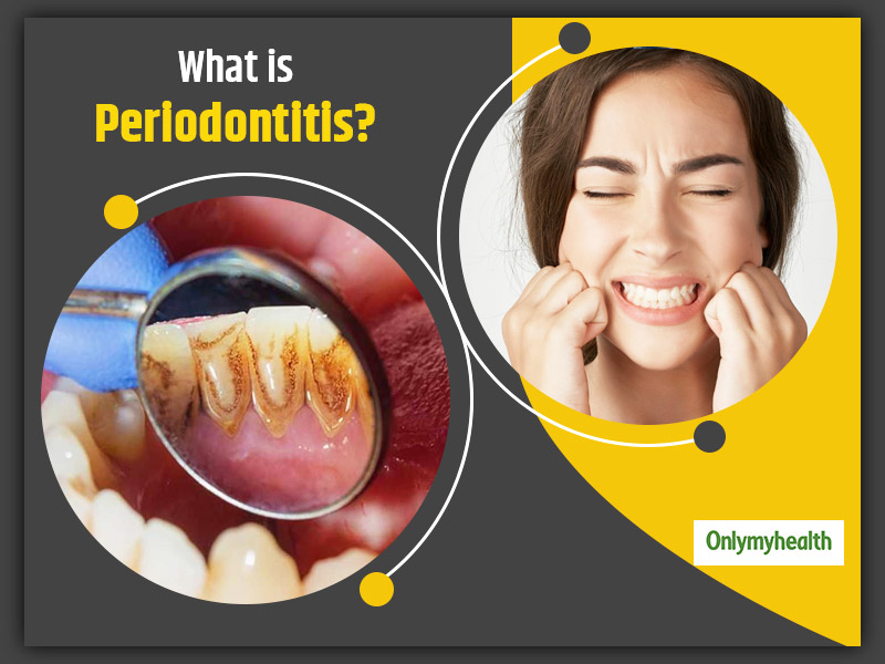 Know All About Periodontitis- Symptoms, Causes & Treatment From Endodontist