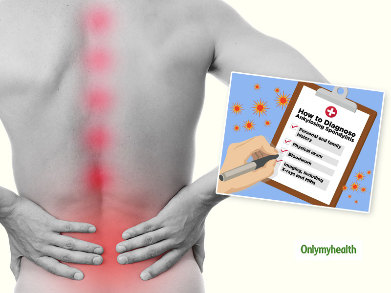 Exercise Dos and Don'ts for Ankylosing Spondylitis