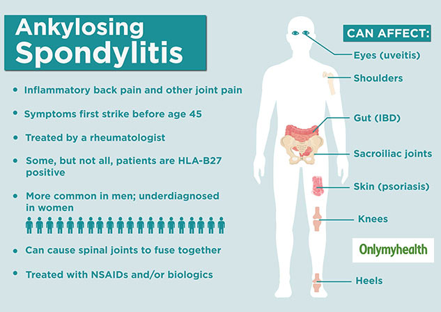 What Is Ankylosing Spondylitis? Symptoms, Diagnosis, Treatment And Tips ...