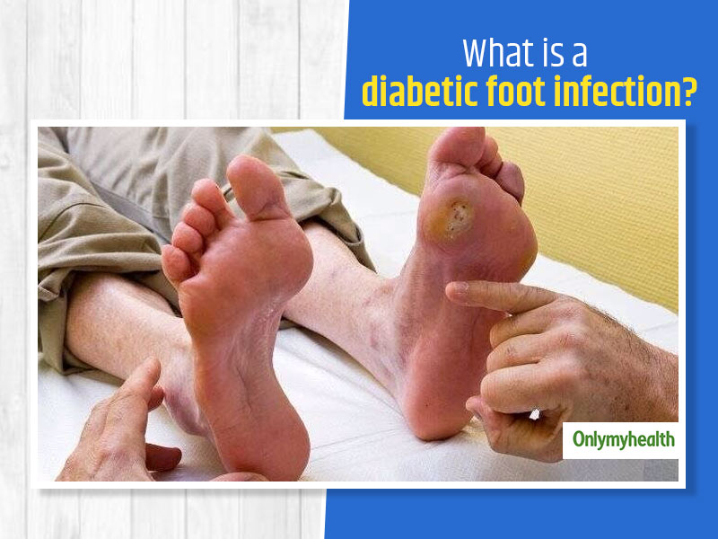 Diabetic Foot Infection Symptoms Risk Factors Treatment And Self Care Tips Onlymyhealth