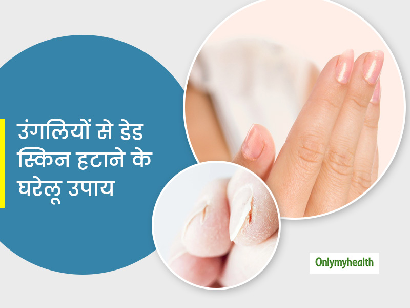 हाथ या चेहरे से पपड़ी की तरह निकलने लगे त्वचा की ऊपरी पर्त, तो आपके बड़े काम आएंगे ये घरेलू नुस्खे	