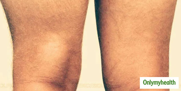 baker's cyst diagnosis and treatment