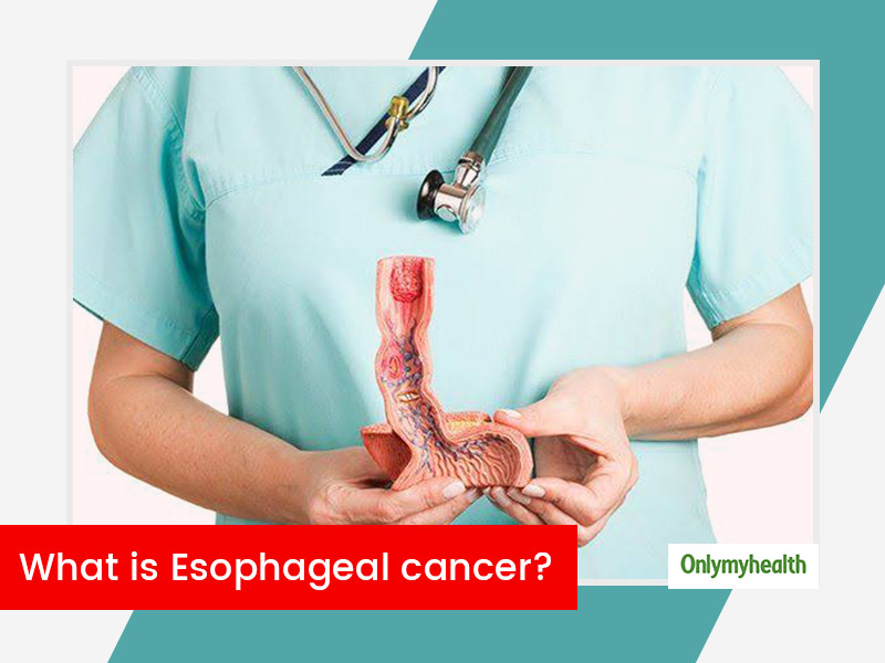 Esophageal Cancer Types Stages Symptoms Causes Diagnosis And Treatment Onlymyhealth 