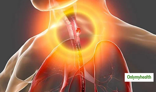 Esophageal Cancer: Types, Stages, Symptoms, Causes, Diagnosis And