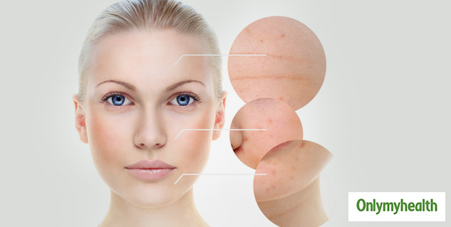 Hazelnuts for Finelines