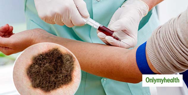 Skin Cancer