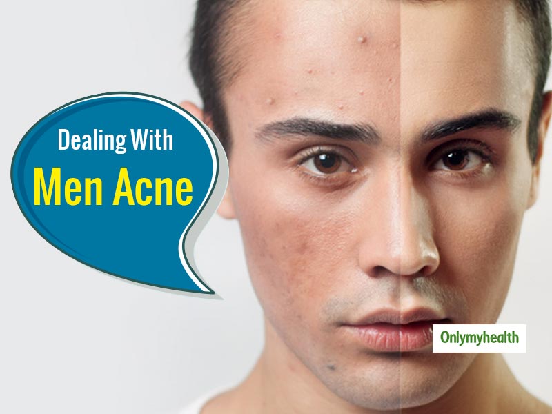 Pimples On Face Removal Tips For Men