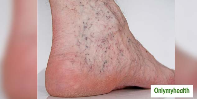 5-signs-on-the-leg-that-indicate-high-cholesterol-level-in-body-in