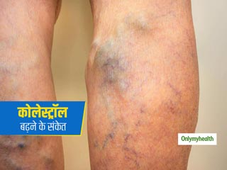 कोलेस्ट्रॉल कैसे पैरों को नुकसान पहुंचाता है? जानें बढ़े हुए कोलेस्ट्रॉल के कारण पैरों में दिखने वाले संकेत