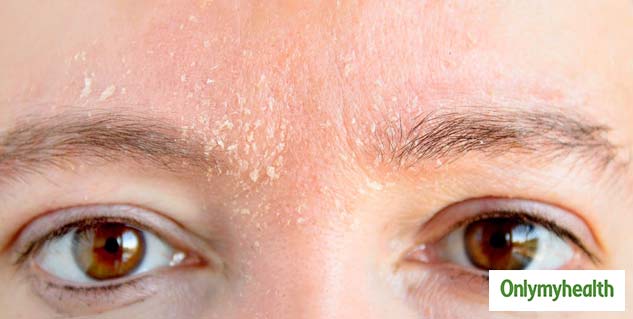 inside_Seborrheic Dermatitis