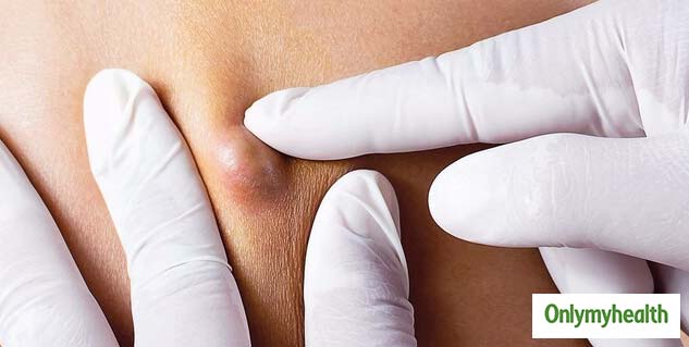 cysts_men