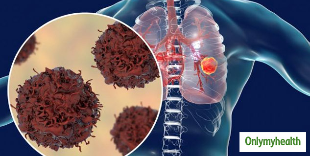 Lung Cancer