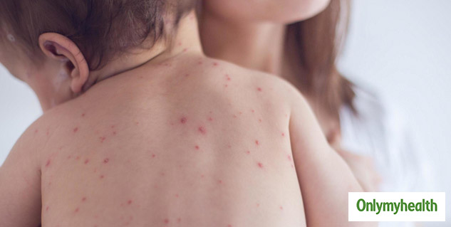 Inside_MEASLES