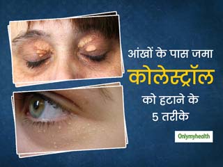 आंखों के पास जमा कोलेस्ट्रॉल को हटाने के लिए क्या करें? जानें 5 मॉडर्न तरीके
