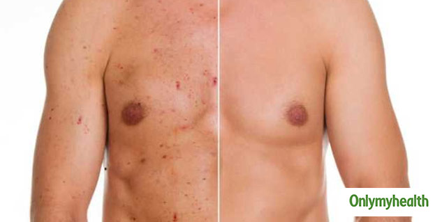 The Real Reason You Get Chest Acne