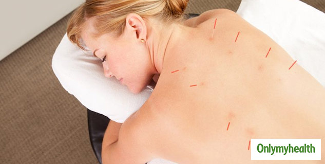 Acupuncture For Epilepsy