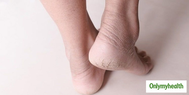relief from Crack Heel