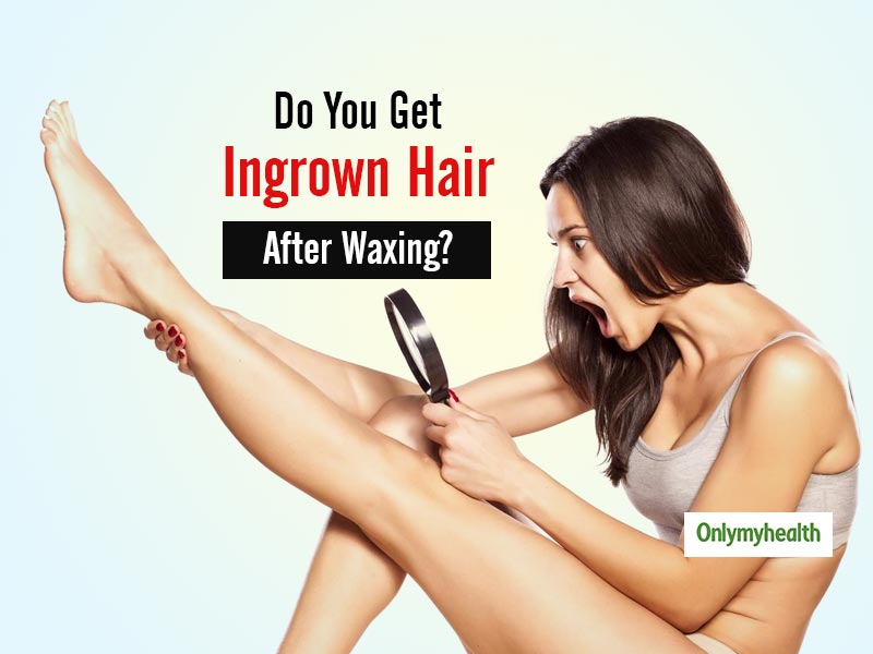Do Ingrown Hair After Waxing Annoy You? Here Are Some Tips & Tricks To Get Rid Of Them