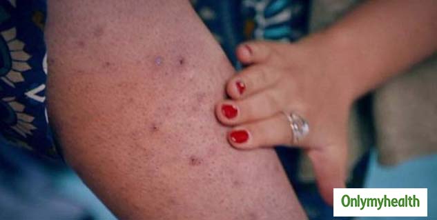 Ingrown Hair 