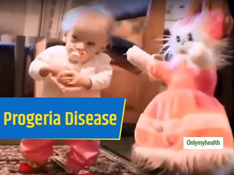 Progeria Disease: Anna Sakidon Died Due To Old Age Disease, Multiple Organ Failure At The Age Of 8