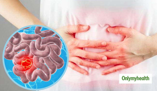 Irritable Bowel Syndrome 