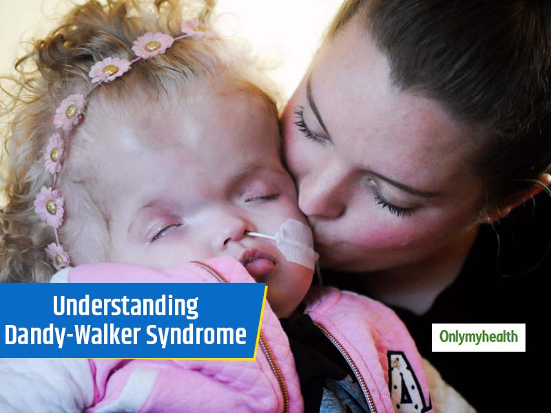 Dandy-Walker Syndrome: All You Need To Know About This Syndrome, Causes And Treatment