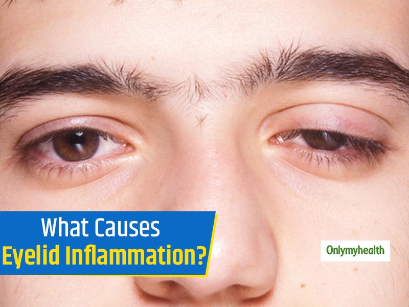 What Makes Eyelid Swell? Know The 5 Major Causes Of Eyelid Inflammation