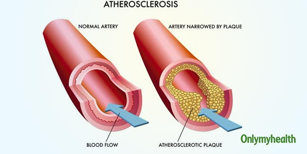 Is Fat Around the Arteries Good For Heart