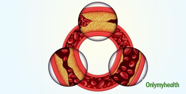  Fat Around the Arteries 