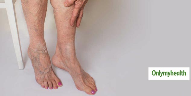 Varicose Veins