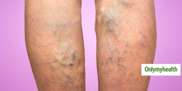 Varicose Veins treatment