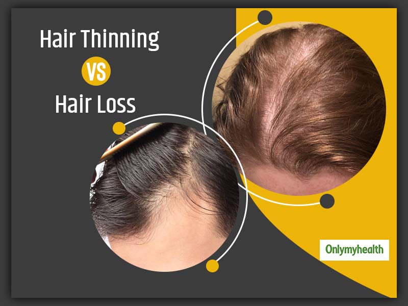 How To Differentiate Between Hair Thinning And Hair Loss? OnlyMyHealth