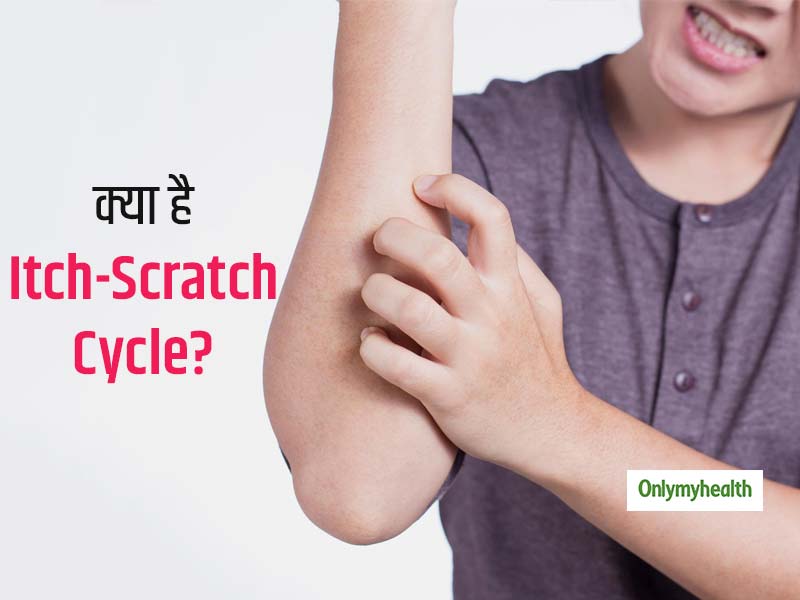 Itch Scratch Cycle Hands Dry Dermatitis And Atopic Eczema 42 Off 