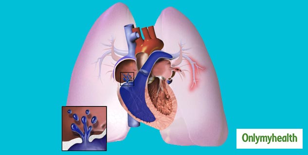 Pulmonary Arterial Hypertension
