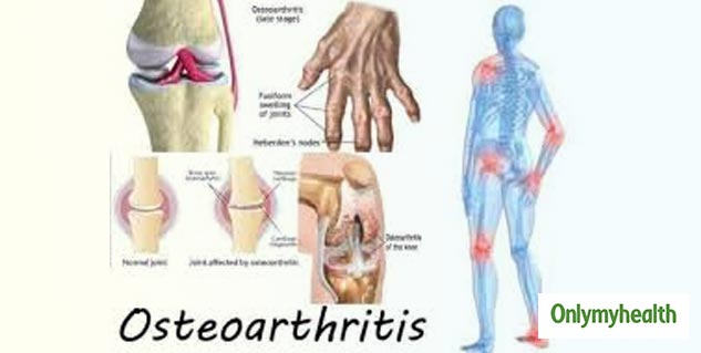 inside_Osteoarthritis