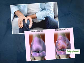 Early Arthritis का संकेत है हड्डियों से  आवाज आना, विशेषज्ञ से जानें ऑस्टियोअर्थराइटिस से जुड़ी सभी बातें  