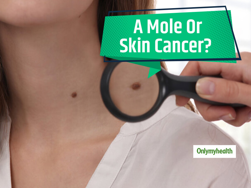 Cancerous Mole Vs Normal Mole