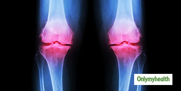osteoarthritis