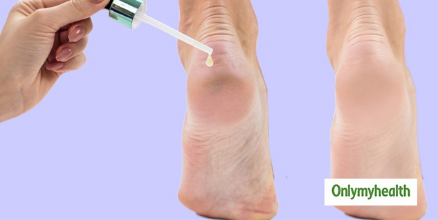 Camphor Oil For Crack Heels 