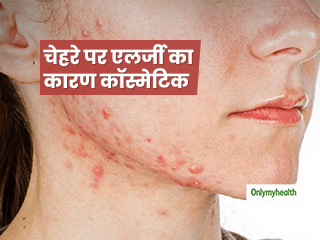 आखिर क्यों कुछ फेयरनेस प्रोडक्ट लगाने से चेहरे पर हो जाते हैं दाने-मुहांसे, जानें एलर्जी होने का कारण