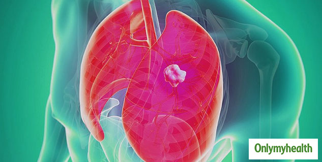 lung cancer