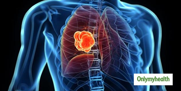lung cancer