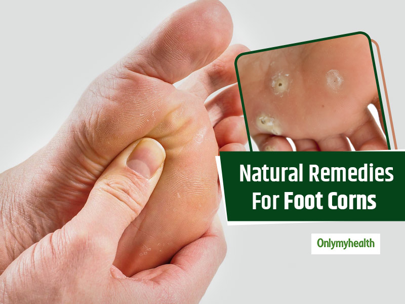 treat-foot-corns-with-these-effective-ayurvedic-tips-onlymyhealth