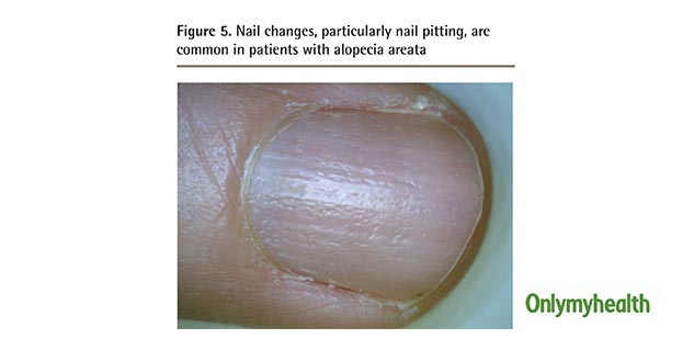 Nail involvement in patients with moderate-to-severe alopecia areata  treated with oral tofacitinib