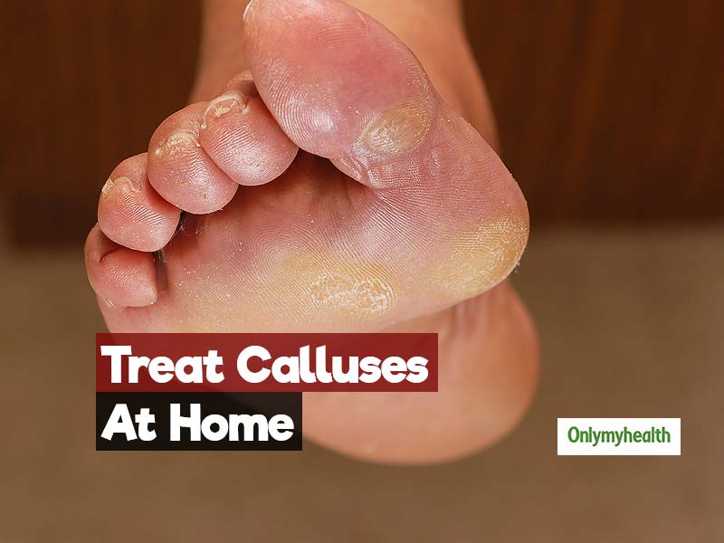 The 2-Ingredient Home Remedy To Treat The Problem Of Calluses