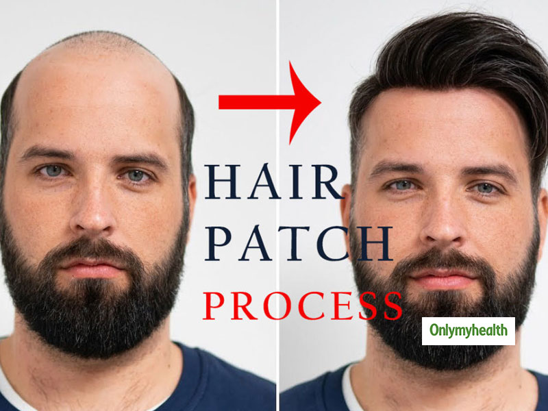 Best Quality Hair Patch - Everything You Need to Know About Hair