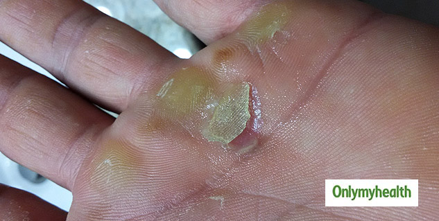 The 2-Ingredient Home Remedy To Treat The Problem Of Calluses