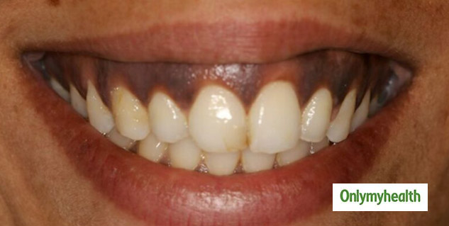 Black Teeth